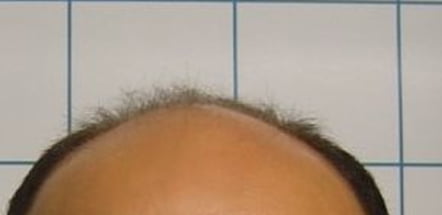 Caso clinico: prima del trapianto capelli FUE
