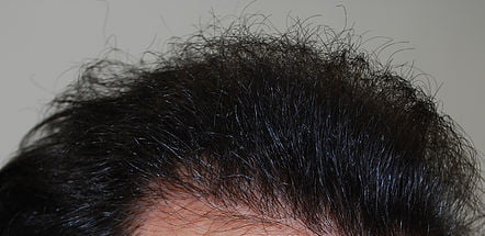 Caso clinico: dopo il trapianto capelli FUE