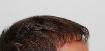 Caso clinico: dopo il trapianto capelli FUE